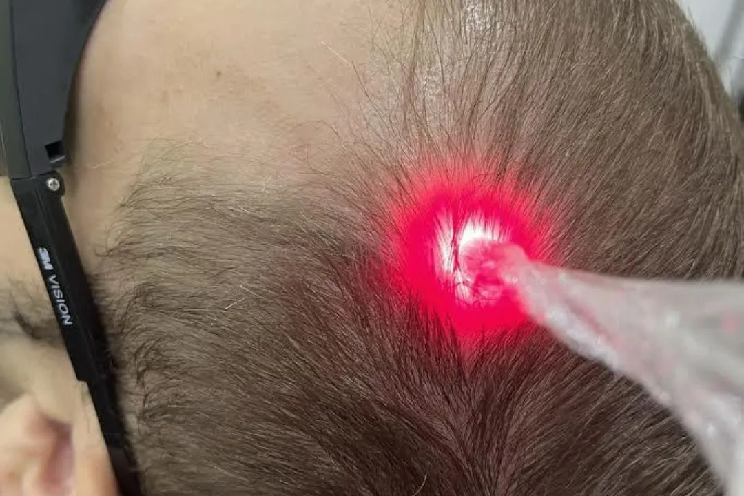 fotobiomodulacao_1